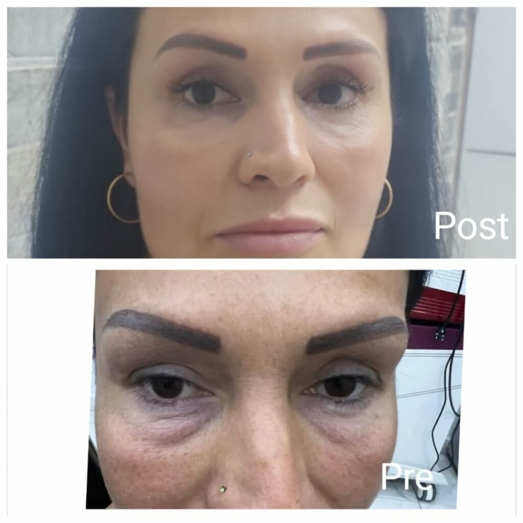 شد الجفون قبل وبعد